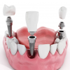 Имплантация зубов - основные особенности.