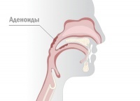 Как лечить аденоиды?