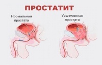 Простатит - симптомы, причины, профилактика и лечение.