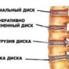 Что такое протрузия диска